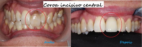 clinica-dentaria-faro-coroa