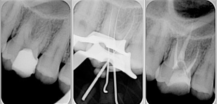 endodontia