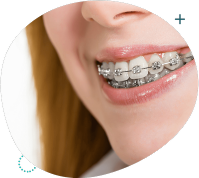 ortodontia-aparelho-dentário