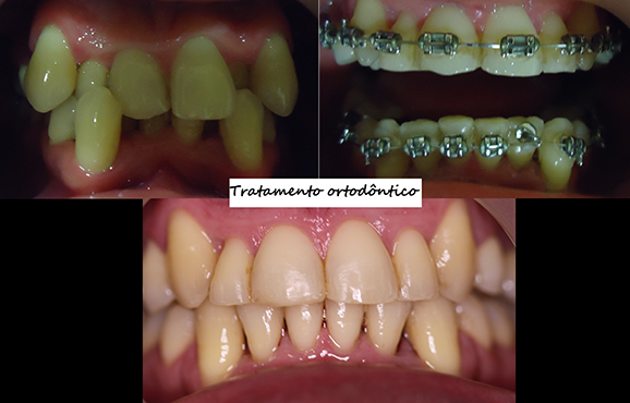 https://clinica-dentaria-faro.pt/wp-content/uploads/2020/09/ortodontia4.png