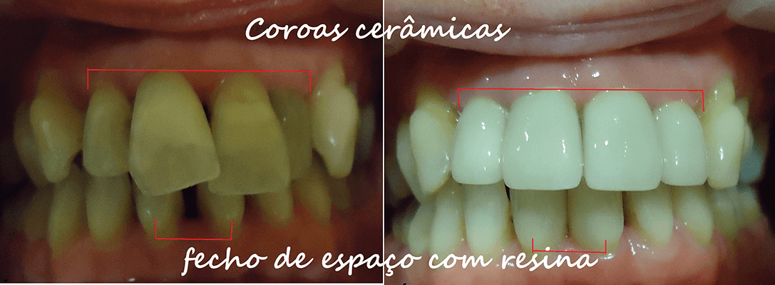 coroas-prótese fixa